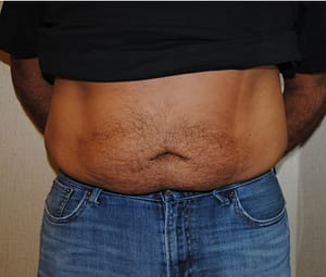 Middle aged man after receiving lipo for abs and love handles