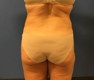 Middle aged woman after receiving lipo for love handles - amazing results in DC