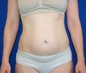 Before picture liposuction (arms, abdomen, hips, flanks, and thighs) and lower abdominal skin excision (“mini tummy tuck” (1)Before picture liposuction (arms, abdomen, hips, flanks, and thighs) and lower abdominal skin excision (“mini tummy tuck”