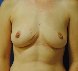 Pre-Pectoral (Over-the-Muscle) Breast Reconstruction DC