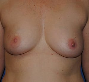 Pre-Pectoral (Over-the-Muscle) Breast Reconstruction