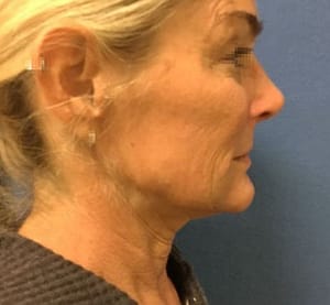 Before Face and Neck Lift
