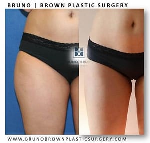 in office liposuction dc