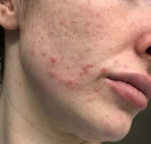 Before photo of a DC patient who received Microneedling with PRP treatment at Bruno Brown