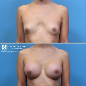 DC Breast Augmentation Procedure