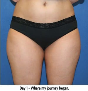 Smartlipo Results DC, Chevy Chase MD