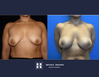 Before and after breast augmentation with breast implants