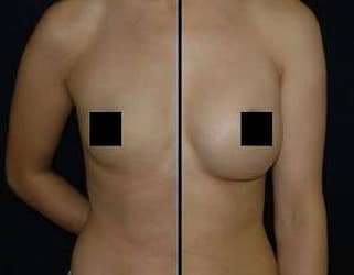 DC BREAST AUGMENTATION