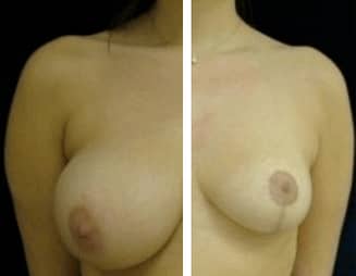 Breast Reduction in Tysons Corner, VA