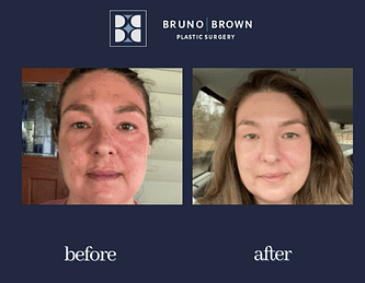 Before and after a chemical peel & facial