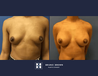 Before and after breast augmentation with breast implants