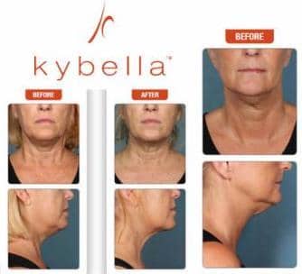 kybella before after images