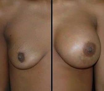 Dulles, VA Breast Implants
