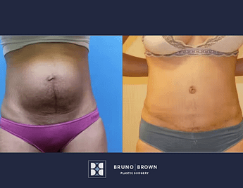 Before and after tummy tuck Washington DC
