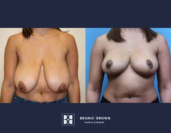 Breast Reduction Before and After