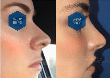 Nonsurgical Nose Job Washington DC