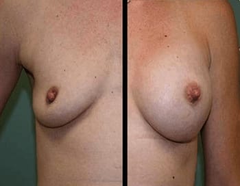 breast augmentation DC