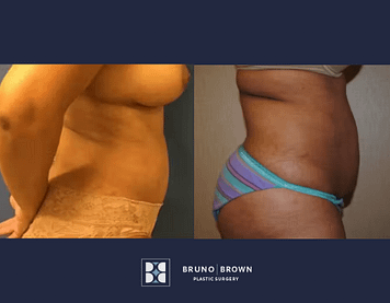 Before and after liposuction Washington DC