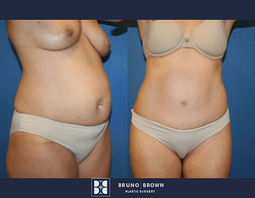 Before and after tummy tuck