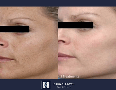 PRP Facial Before and After 