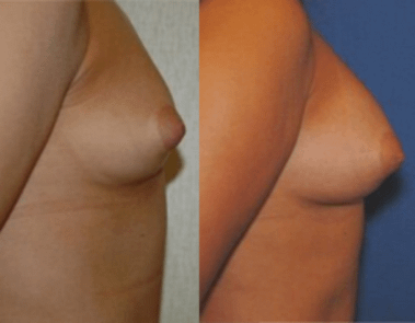 Fast Grafting Breast Augmentation Before & After