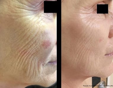 Microneedling with PRP