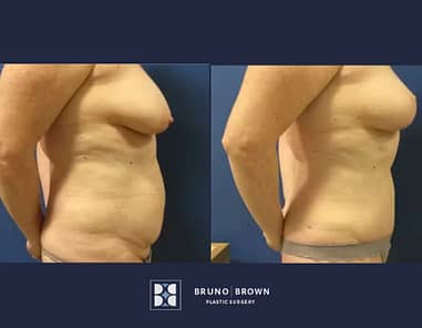 Before and after Tummy Tuck Washington DC