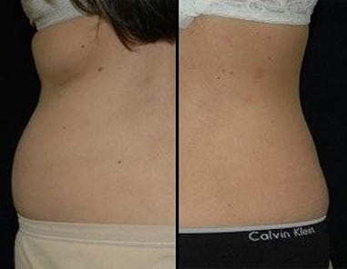 BEFORE + AFTER: Permanent fat reduction (back of bra bulge) An extremely  common area for so many women when it comes to that unwanted b