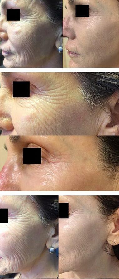 Pre and post procedure photographs of fractional CO2 laser withprp patients