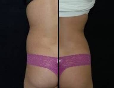 Liposuction Bethesda