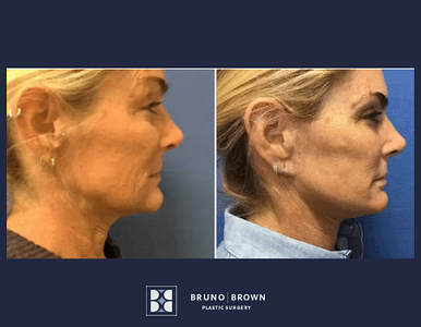 Before and after Facelift