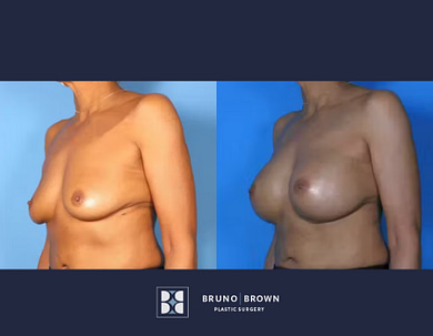 before and after of a breast augmentation for a middle age women