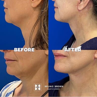 The difference in the neck after a face and neck lift