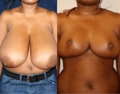 Breast Reduction in DC