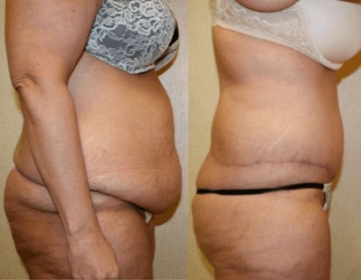 DC Tummy Tuck before after image