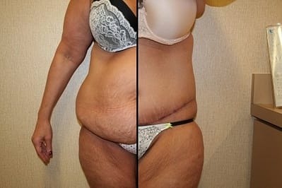 DC tummy Tuck