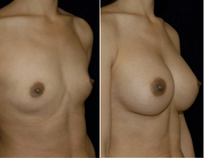 Breast Implants Bethesda
