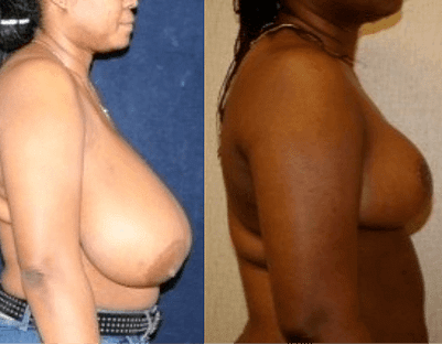 Breast Reduction in DC