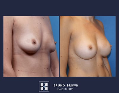 Breast augmentation before and after 