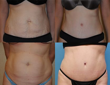 Bethesda Tummy Tuck, before and afters