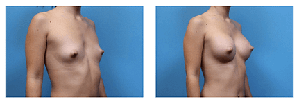 Breast Implants Breast Implants