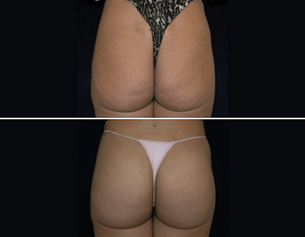 Brazilian Butt Lift Before and After