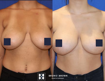 Breast augmentation before and after