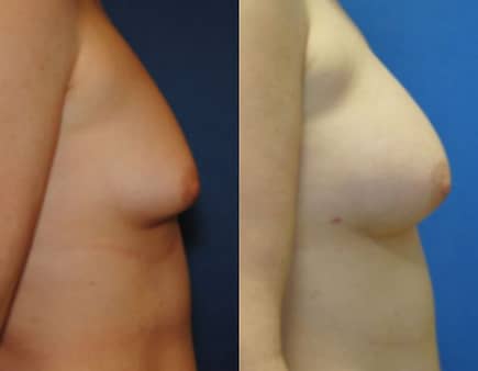 Breast Augmentation With Fat Grafting, before and after