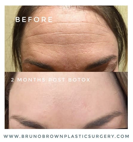 Botox-results