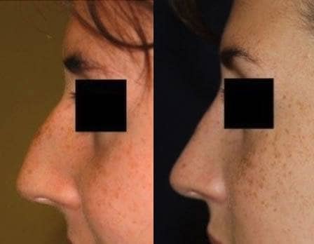 DC Rhinoplasty before and after results