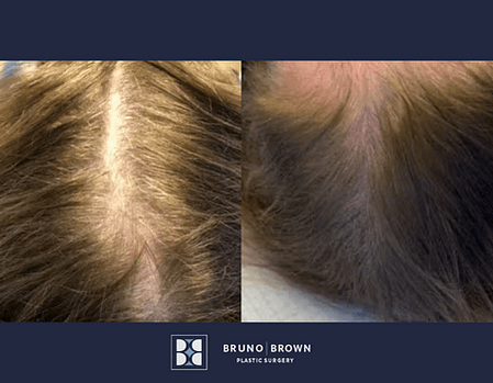 Before and After PRP for Hair Loss