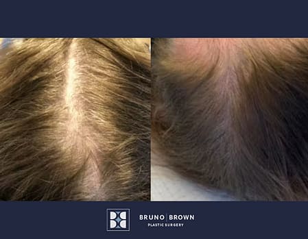 Before and After PRP for Hair Loss