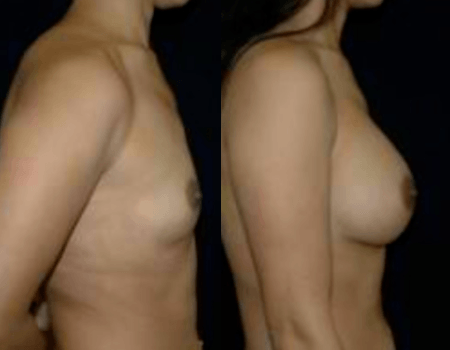 DC Breast Implants