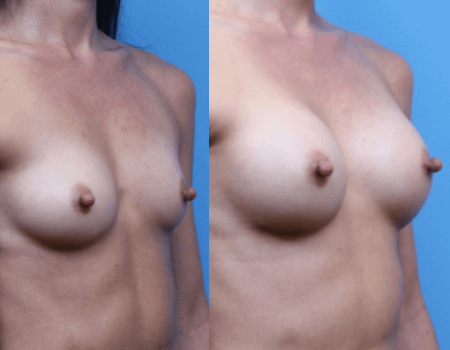 Breast Implant DC